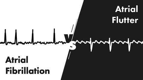 Atrial Fibrillation Vs Atrial Flutter