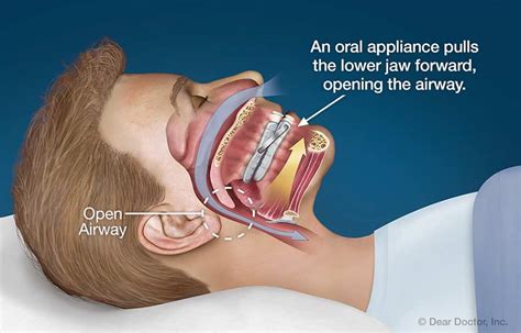 Snoring Applications | Niagara Peninsula Orthodontics | St. Catharines ...