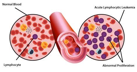 Blood Cancer Types and Stages