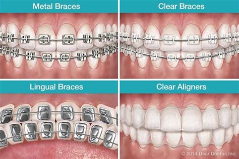 Teeth Braces And It's Types