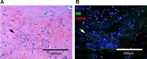 Identification of Neutrophil Extracellular Traps in Paraffin-Embedded ...