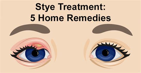 Stye Treatment: 5 Home Remedies - David Avocado Wolfe