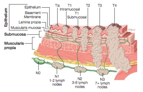 Pathology Outlines - Staging