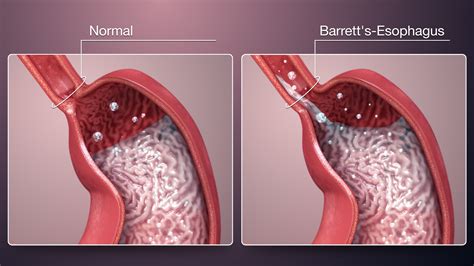 Acid Reflux Esophagus Cancer ~ Gastric reflux and asthma