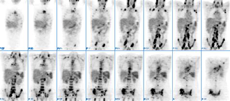 Pet Scan Images Of Lymphoma