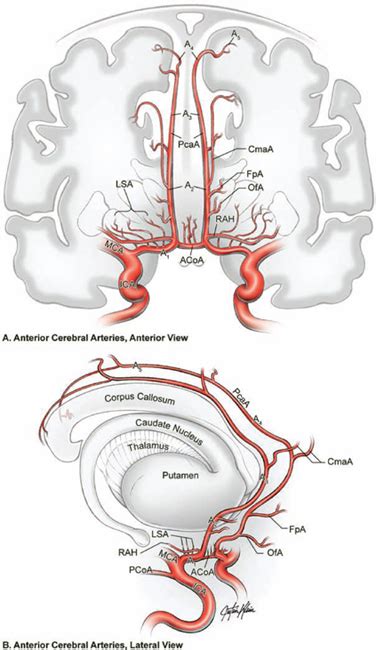 Anterior Communicating Artery Aneurysms | Neupsy Key