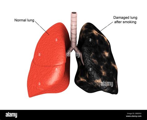 Non Smoker Lungs Vs Smoker