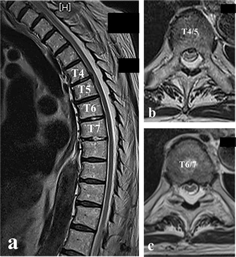 Spine Mri Labeled