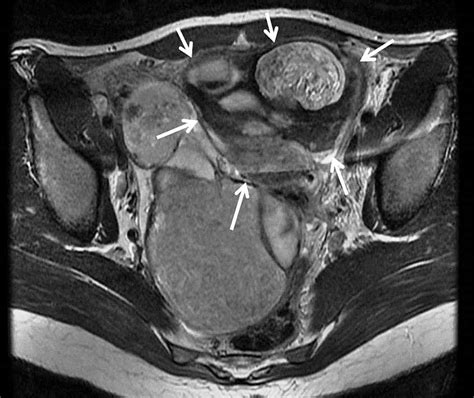 Cureus | A Missed Diagnosis of Ovarian Torsion in a Patient with ...