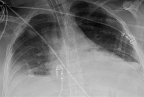 A Curious Case of Refractory Hypoxemia - CriticalCareNow