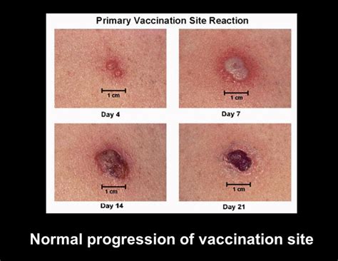 BCG Vaccination | Pakenham Medical Clinic