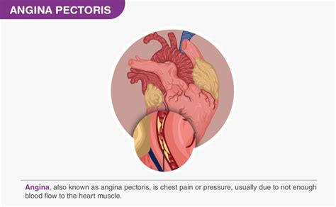 Angina Pectoris- Meaning, Types, Symptoms & Treatment