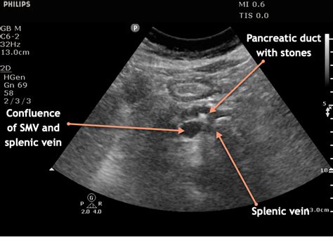 Pancreatic Duct Ultrasound