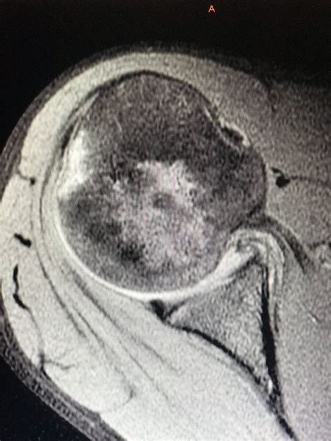 MRI Hill-Sachs lesion - JR Rudzki, MD