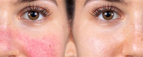 Rosacea Vs Lupus Butterfly Rash