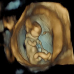 Nuchal Translucency Scan | Fatima Gani