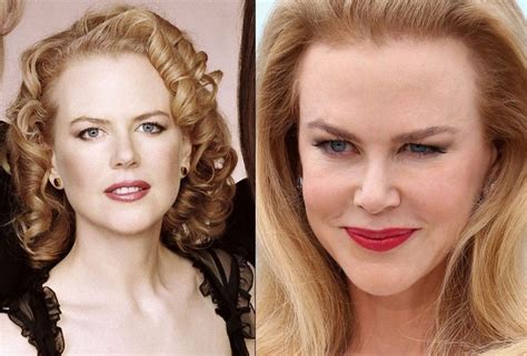 Nicole Kidman plastic surgery (26) – Celebrity plastic surgery online