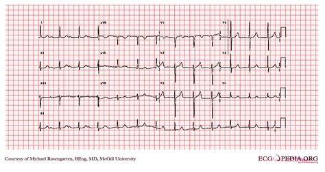 Ecg Examples Of Heart Blocks