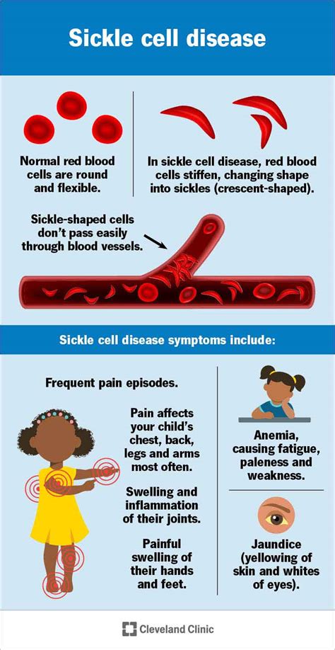 Sickle Cell Disease (SCD): Types, Symptoms & Causes