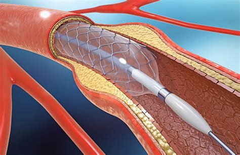 Innovative Program Streamlines Access to Cardiac Catheterization for ...