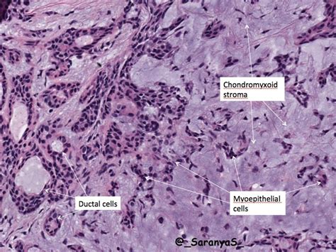 Pleomorphic Adenoma (PMA) : 네이버 블로그