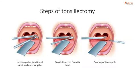 Tonsillectomy Procedure Step By Step