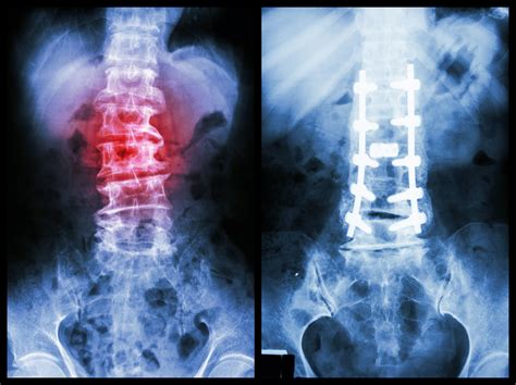 Diagnosing Spondylolysis | PainScale