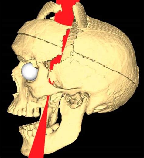 A New Way of Thinking: the Wounds of Phineas Gage - Historic Mysteries