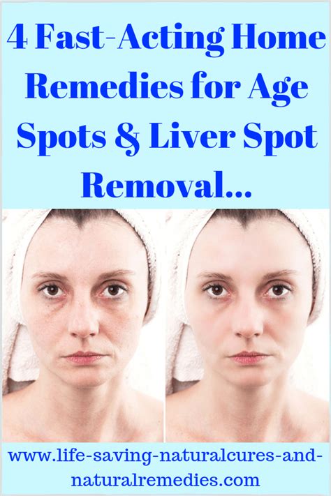 4 Fast-Acting Home Remedies for Age Spots & Liver Spots... | Liver spot ...