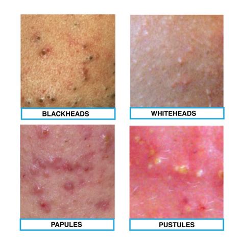 The four types of acne: blackheads, whiteheads, papule and pustules ...