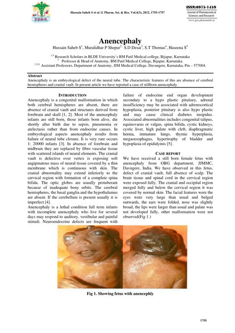 (PDF) Anencephaly