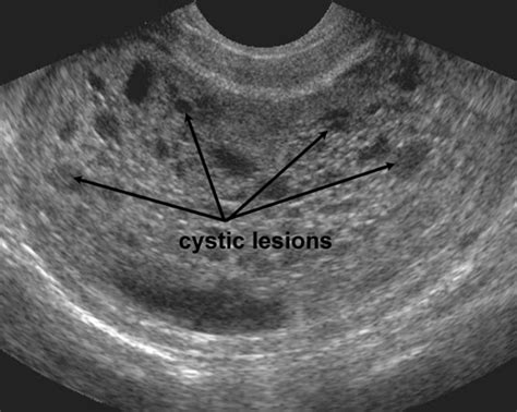 Molar pregnancy - WikEM