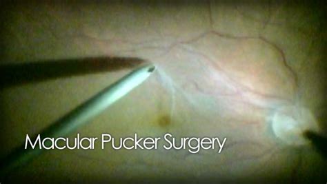 Macular pucker removal - surgical video footage