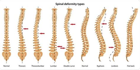 Spine Deformity - Types, Causes, and Treatments | Sattvik Spine | Spine ...