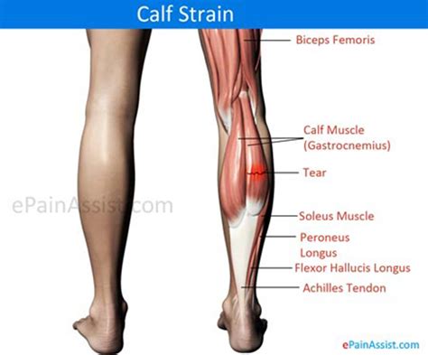 Calf Strain|Treatment|Symptoms|Recovery|Causes|Prognosis