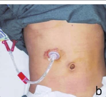 a: Endoscopic view, showing PEG tube in stomach. b: PEG tube placed on ...