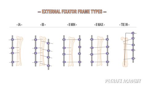 External Fixator System Application Types