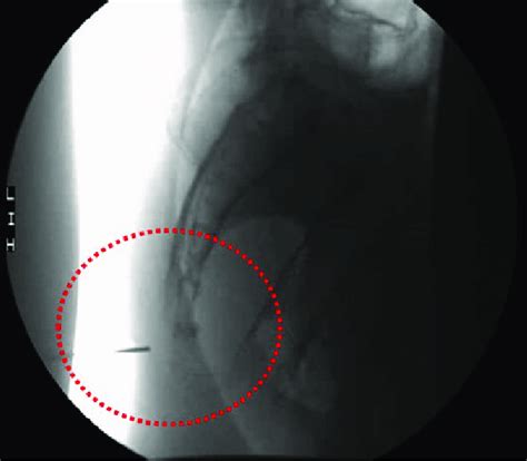 Ganglion impar neurolysis procedure part 1: needle placement (circle ...