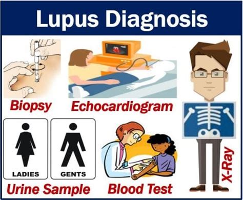 Lupus diagnosis and different types of tests doctors order - MBN Health