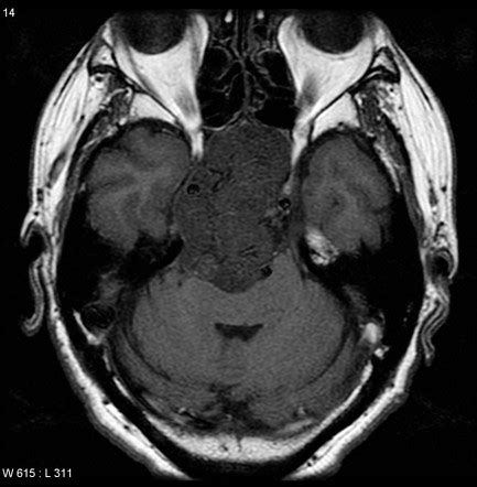 Clival masses | Radiology Reference Article | Radiopaedia.org