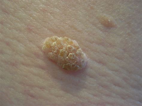 Seborrheic Keratosis Treatment Glasgow | Ever Clinic