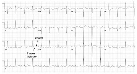 EKG of our patient showed T wave inversions and U waves consistent with ...