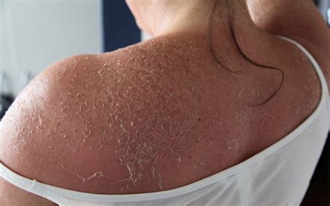 How To Stop Peeling Skin From Sunburn?