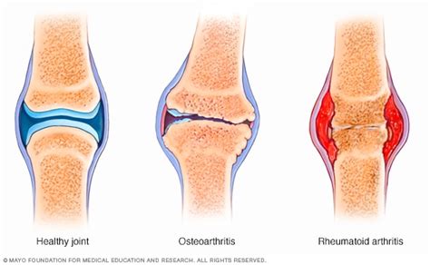 Rheumatoid arthritis - Symptoms and causes - Mayo Clinic