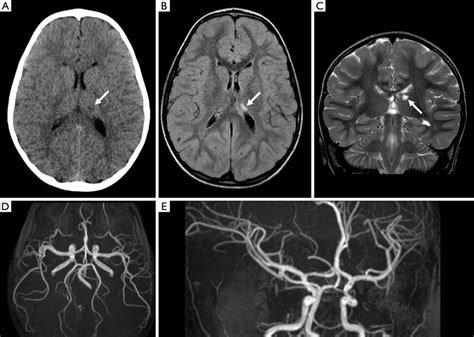 Head CT, brain MRI and MR angiography (MRA) at clinical onset. (A ...