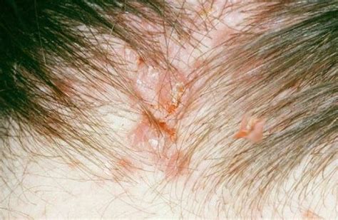 raised bumps on scalp - pictures, photos