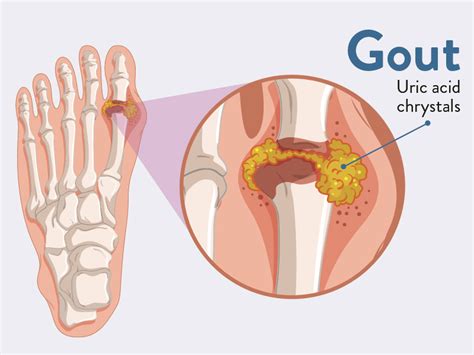 Gout Symptoms, Management and Treatment