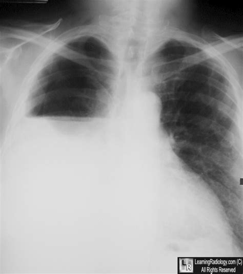 Learning Radiology - Hydropneumothorax