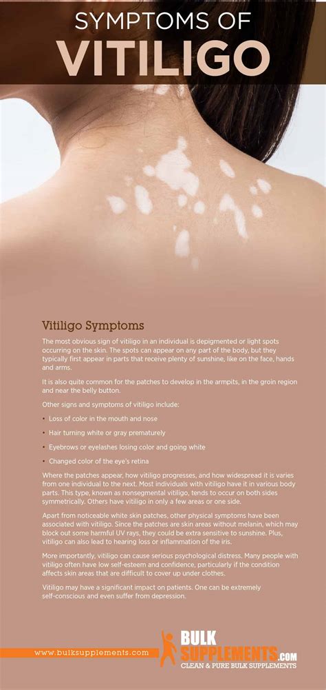 Tablo | Read 'Vitiligo: Symptoms, Causes & Treatment' by