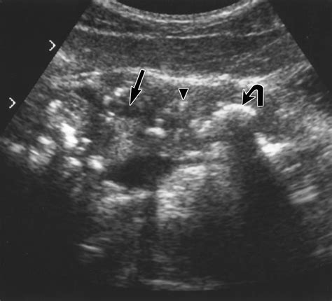 Chronic Pancreatitis Ultrasound